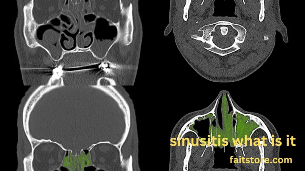 sinusitis what is it