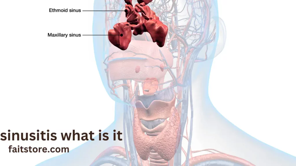 sinusitis what is it